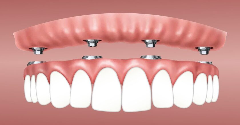 Cost of Full Mouth Dental Implants: What You Need to Know